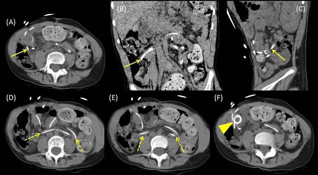 Faint serpiginous radiotracer uptake is seen adjacent to the central collection at 60 minutes (arrowhead). A CT abdomen/pelvis was recommended with concern for pseudocyst formation.