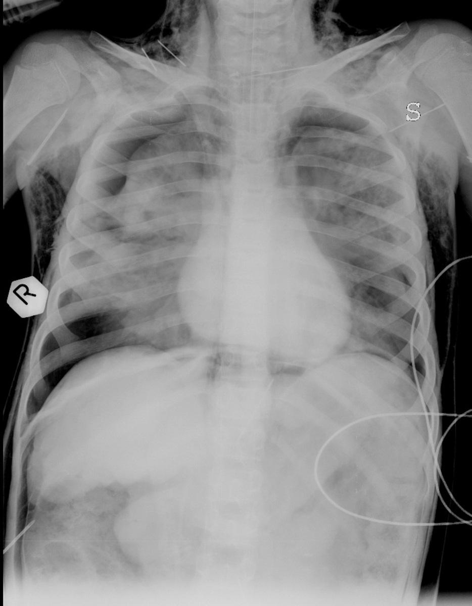 Fig. 5: Supine chest X-Ray in a pediatric patient with pre-existing pulmonary disease