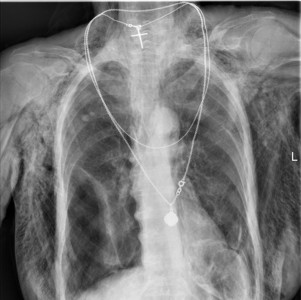 Fig. 1: Upright chest X-Ray in a patient after thoracic trauma - massive subcutaneous emphysema, bilateral partial pneumothorax,
