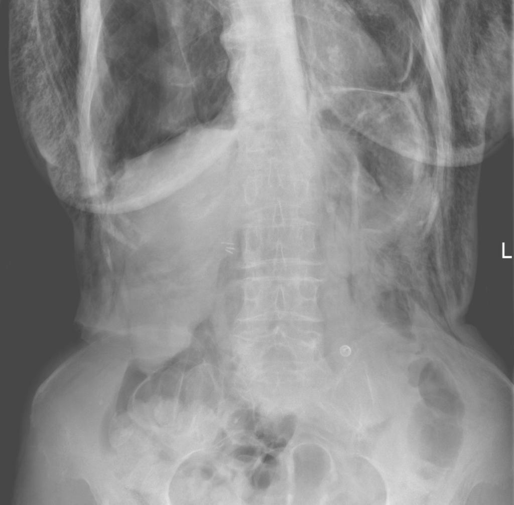 Fig. 2: Upright plain abdominal X-Ray in a patient after thoracic trauma, signs of pneumoperitonem - subtle crescent lucency below the right hemidiaphragm - "crescent