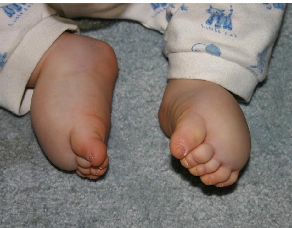 Types of lymphedema Primary lymphedema: Milroy s (10%), hereditary, manifests at birth typically in feet and lower legs.