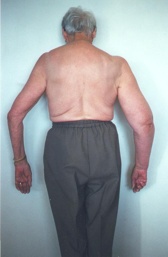 Types of lymphedema Secondary lymphedema: Insufficient lymph vessels to manage normal amount of