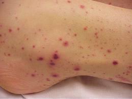 3. Clinical features: bleeding Petechiae and ecchymoses Blood oozing: Wound sites Intravenous lines/catheters Mucosal surfaces