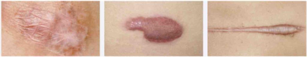 Scar Type Prevention of hypertrophic and keloid scars Immature hypertrophic scars Linear hypertrophic scars Recommended Clinical Treatment Silcone should be considered as first line prophylaxis If