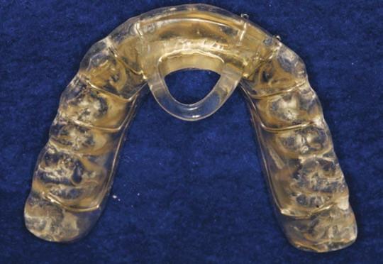 If the diagnosis is that the muscle spasms are being caused by occlusal interferences, then occlusal adjustments will be the treatment of choice to eliminate the extra-capsular problems.