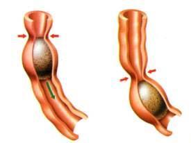 Esophagus A series of contractions of smooth muscle squeeze the food through the esophagus. This is called peristalsis.