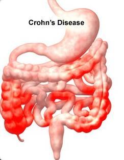 Crohn s Disease