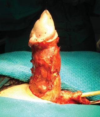 Patients/Materials and Methods Between January 2006 and January 2011, 13 patients, aged 13 to 22 years, underwent redo surgery due to failed epispadias repair in childhood.