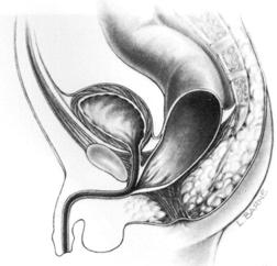 will have associated genitourinary abnormalities Likelihood increases as the fistula level