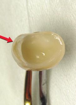 sufficient retention for a ferrule retained, cemented crown due to the loss of the