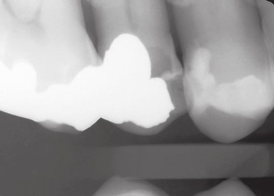 A patient presented with a fractured palatal cusp on tooth 15 2.
