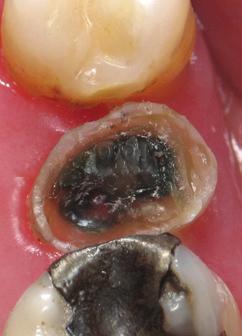 Removal of the old amalgam revealed the buccal cusp fracture 4.