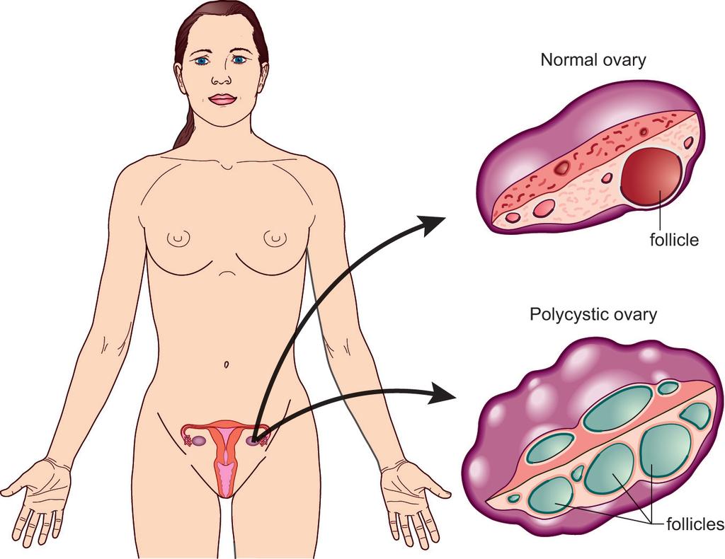 Polycystic ovary syndrome (PCOS) is a condition which can affect a woman s menstrual cycle, fertility, hormones and aspects of her appearance.