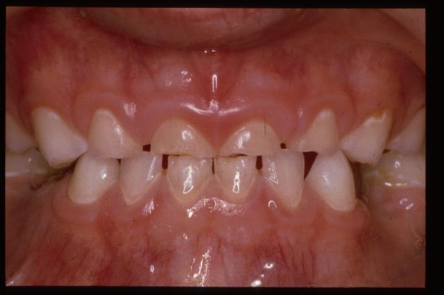 To Control Caries in Populations We Should Focus on Sound and Initial Lesions After Two Years Baseline