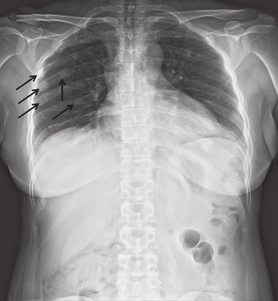 Hyun Jung Lee, et al. nosed in a 44-year-old woman who visited our hospital due to multiple non-traumatic rib fractures.