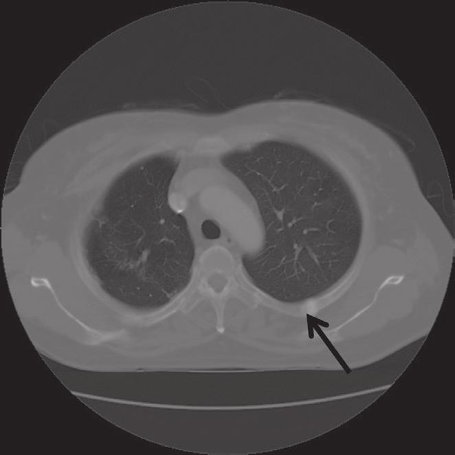 There were multiple rib fractures (Fig. 1). For further evaluation, she had a chest computed tomography (CT) scan Fig. 1. Chest X-ray showed multiple sclerotic lesions of right 4th, 5th, 6th and 7th ribs.