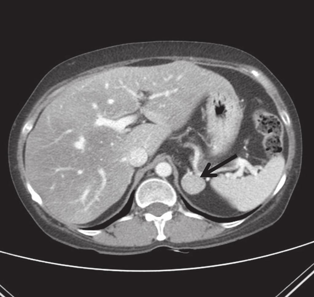Multiple Rib Fractures with Cushing s Syndrome A B Fig. 3. Abdominal computed tomography showed a 2.5 2.0 cm sized mass (black arrow) on the left adrenal gland. tively.