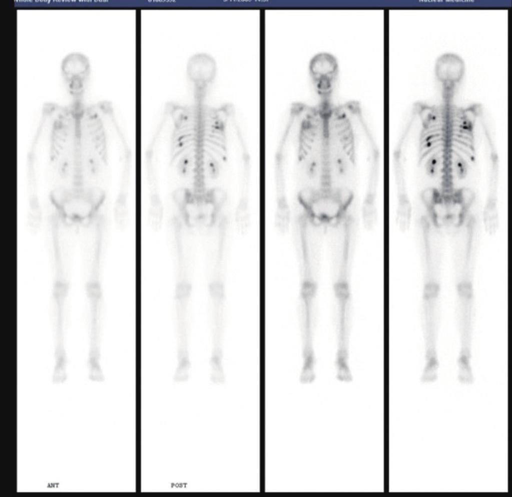 Hyun Jung Lee, et al. A B Fig. 4. (A) Bone scan showed multi-focal increased uptake in the ribs of both sides.