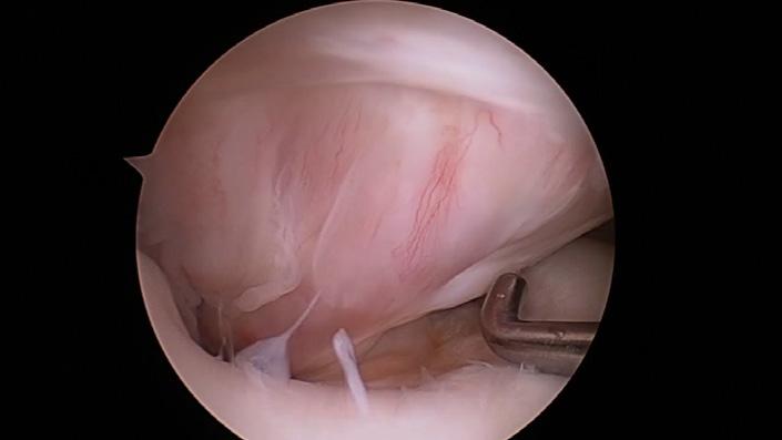 A number of variations have been introduced to the ACL reconstruction technique such as the use of double bundle rather than single bundle graft, retention of the remains of the ACL and variations in