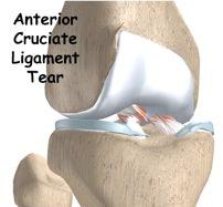 ACL injuries.