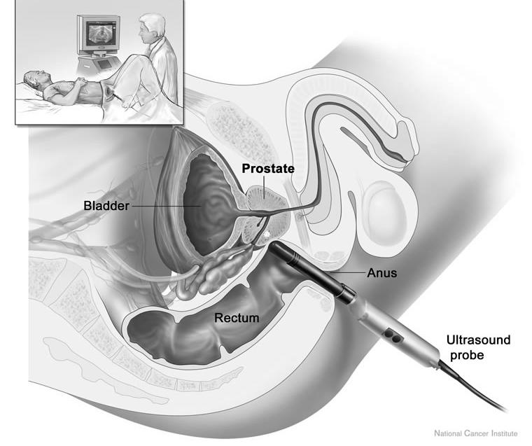 Prostate Cancer Work-up Imaging studies Transrectal ultrasound (TRUS) CT scans Abdomen/pelvis Bone Liver/spleen Brain Chest x-ray Prostate Cancer Work-up
