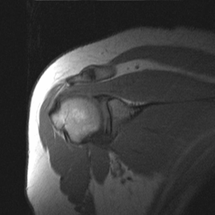 Approach to Shoulder MRI 1. STIRs -look for edema (high intensity) 2.
