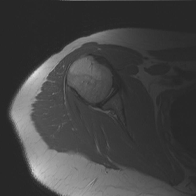 Approach to Shoulder MRI 1. STIRs -look for edema (high intensity) 2.