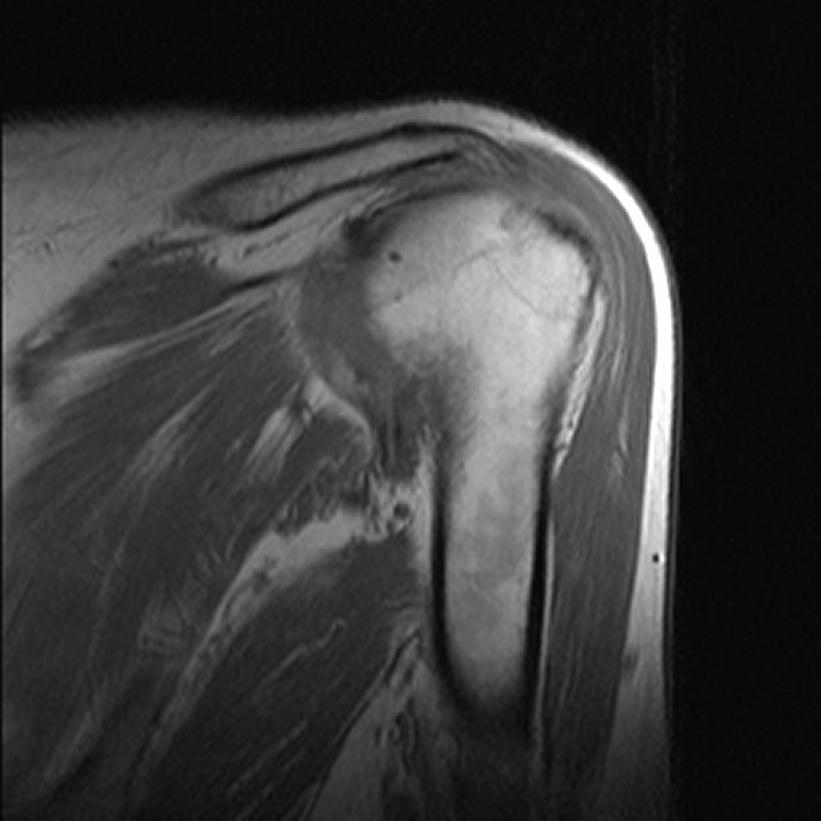 Findings: Our Patient: MRI 1. Hyperintense lesion through full thickness of supraspinatus 2.