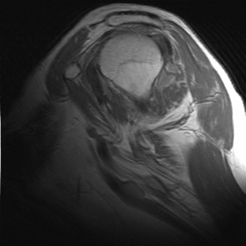 Findings: Our Patient: MRI 1. Hyperintense lesion through full thickness of supraspinatus 2.