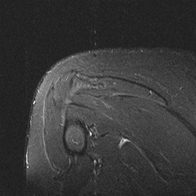 Approach to Shoulder MRI 1.