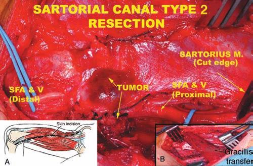 B. The sartorius muscle is detached proximally to allow better exposure and soft tissue reconstruction. C.