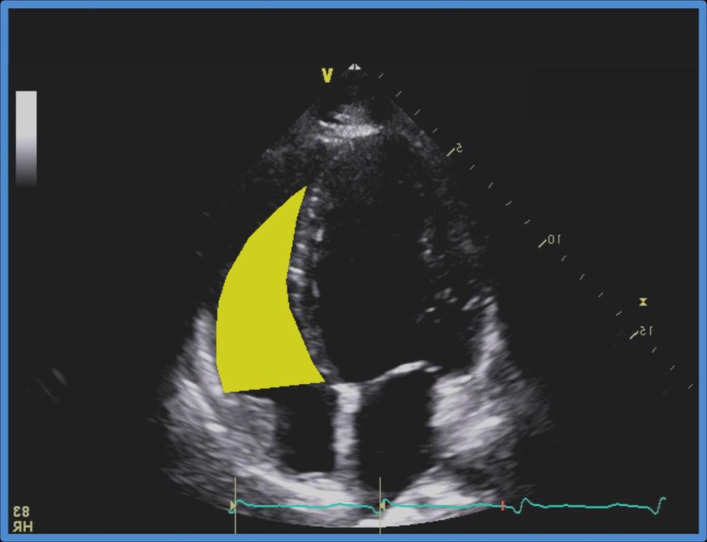 Right ventricular area Normal RV EDA: 25 cm