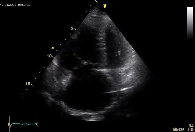 RV Assessment by Echo RV Function -RV Size, Volumes, Pressures, -Factional Area, -TAPSE, TDI: Peak systolic wave velocity, acceleration time, -Tricuspid annular dilation, -Severe leftward shifting of