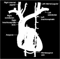 Superior Vena Cava o Formed by the union of the right and left brachiocephalic veins.