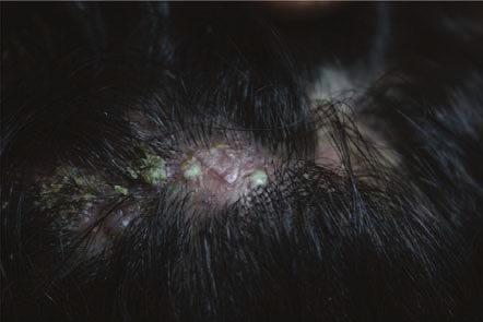 186 Hair and Scalp Disorders initial lesion is erythema follicular pustule and papule. These can be painful and itchy.