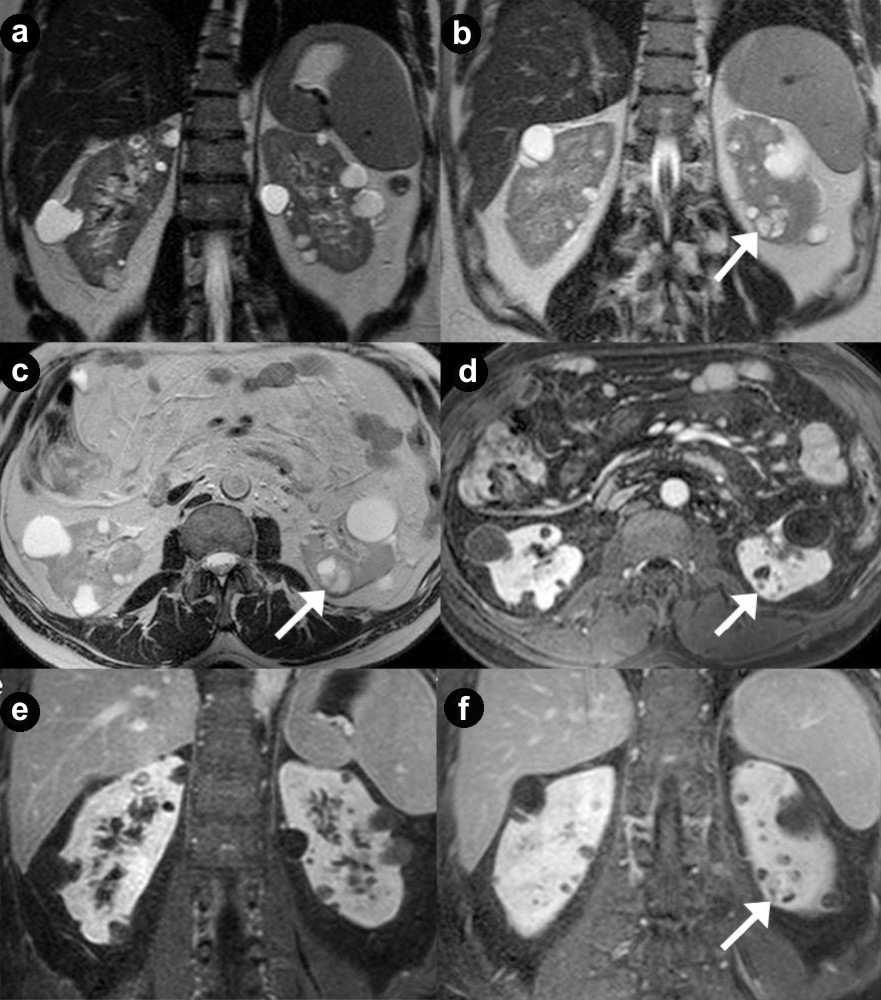 Figure 7. Renal cysts and cystic renal cell carcinoma. A 43-year-old man with VHL disease. Coronal (a. b.) and axial (c.) T2-weighted MR images; axial (d.) and coronal (e. f.
