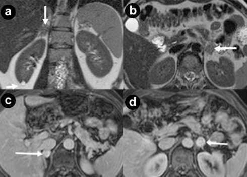 Figure 8. Adrenal pheochromocytomas. A 38-year-old man with VHL di