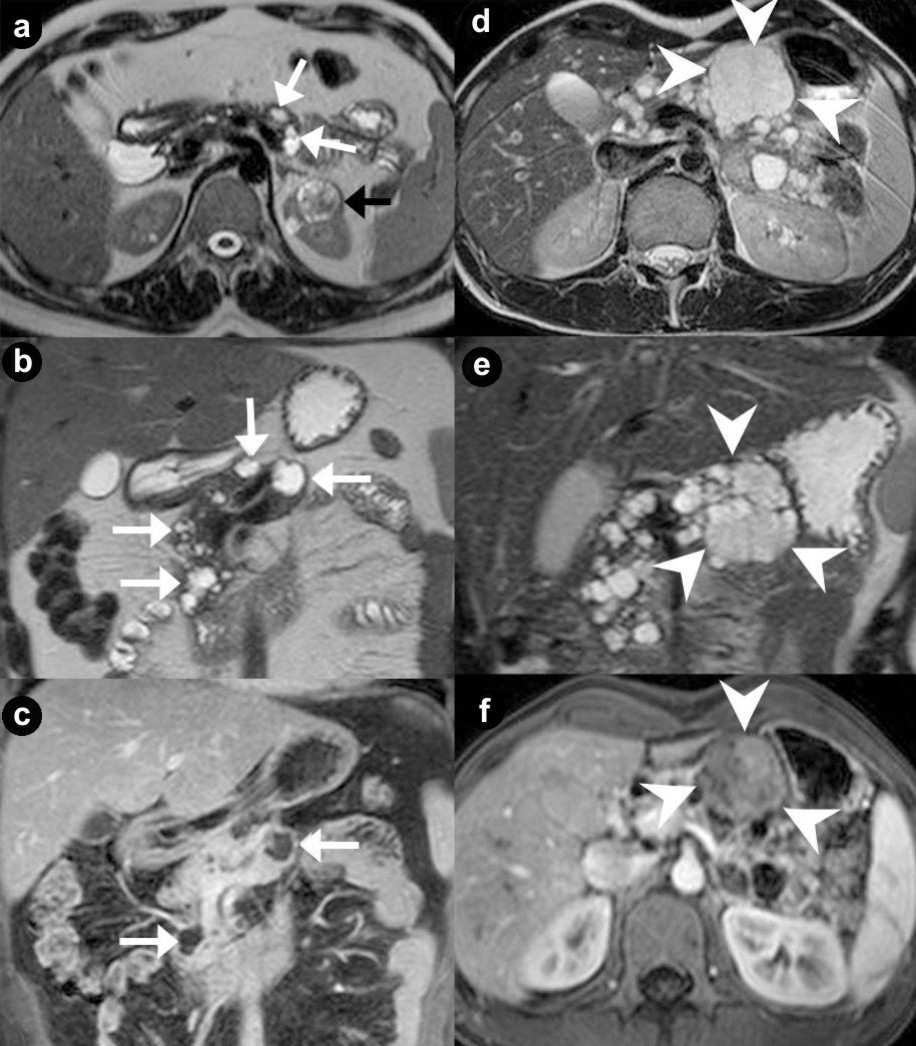 Figure 1. Pancreatic unilocular cysts (a. b. c. Case#1: 35-year-old man with VHL disease). Pancreatic microcystic serous cystadenoma (d. e. f. Case#2: 30-year-old man with VHL disease). Axial (a. d.) and coronal (b.