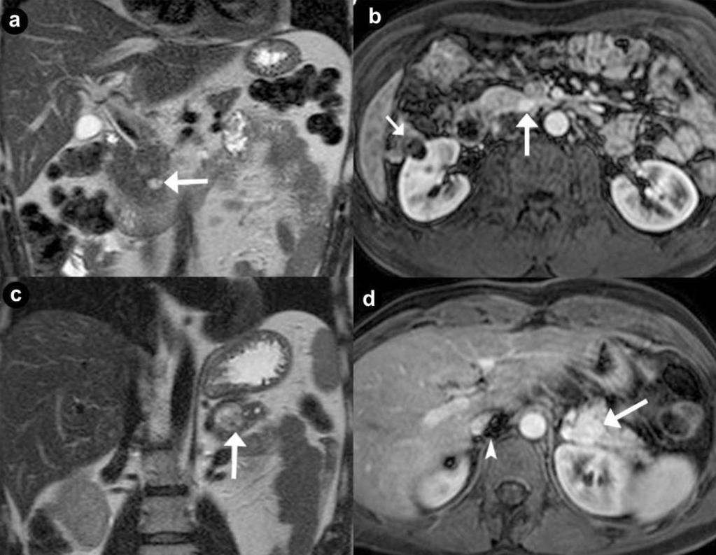 Figure 2. Pancreatic non functioning neuroendocrine tumors. Two cases suffering from VHL syndrome: a 39-year-old man (a. b.), and a 37- year-old man (c. d.). Coronal (a. c.) T2-weighted MR images; axial (b.
