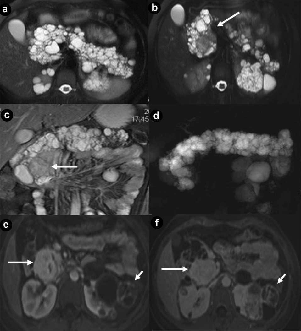 Figure 4. Pancreatic diffuse microcystic serous cystadenoma and pancreatic non functioning neuroendocrine tumor in the same patient.