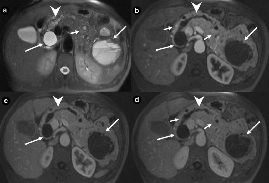 Figure 6. Pancreatic diffuse cystic non functioning neuroendocrine tumor. A 43-year-old woman affected by VHL disease. Axial T2-weighted MR images (a.