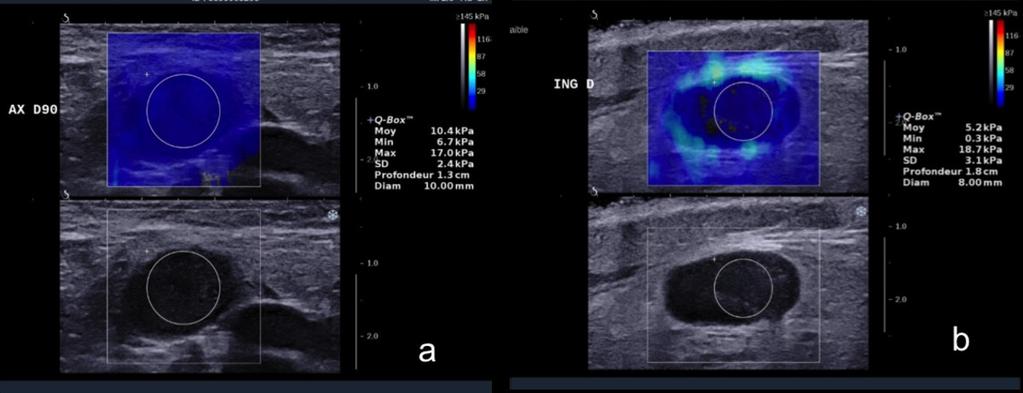 Fig. 1: Fig 1: SWE elastograms and B mode ultrasound of lymph nodes localized in the axilla (a) and in the inguinal area (b). B mode showed same hypoechoic pattern of the Lns with loss of hilum.