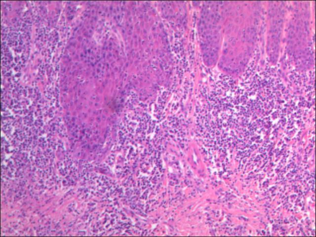 (Figure 1.2). The Histopathological examination reported as verrucous carcinoma without any lymphovascular invasion with negative margin (Figure 1.3 & Figure 1.4).