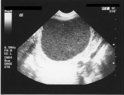 Pelvic US useful in the identification of ovarian endometrioma with homogeneous hypoechogenic cystic features and those