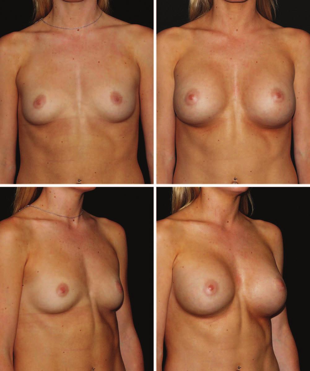 Plastic and Reconstructive Surgery July Supplement 2014 Fig. 3.