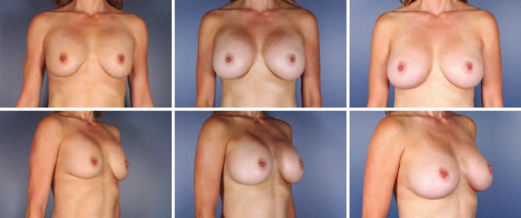 Photographs demonstrate upper-pole shape change between round and shaped implants in the same patient. Used with permission from David L. Kaufman. Copyright 2014, David L.