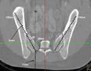 (15%) violated posterior cortex of ilium All screws in-line with S1 Anterior Medial aspect of ilium.