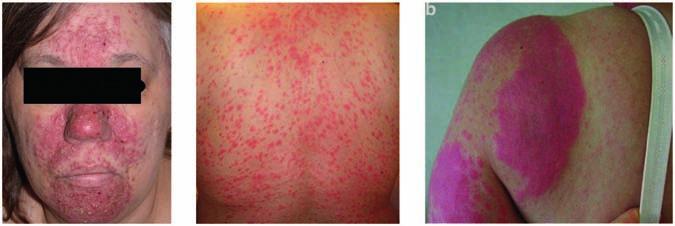 monly associated with EGFR inhibition. It is defined as the eruption of papules or pustules and typically occurs on the scalp, upper chest and back.