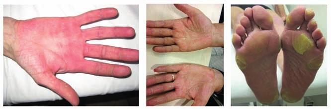 VEGFR-ASSOCIATED DERMATOLOGICAL TOXICITIES GRADE 1 GRADE 2 GRADE 3 Minimal skin change