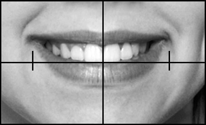 SMILE ESTHETICS AND ABO GRADING Figure 1. A standardized smile image using the 3-in 5-in template. 581 vertical tick-marks inset three-quarters of an inch from the border of the template.